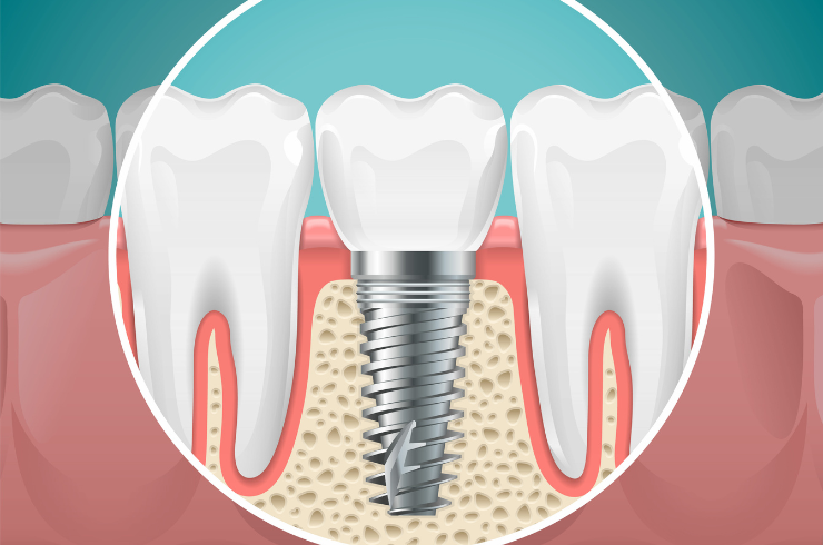 Dental implant