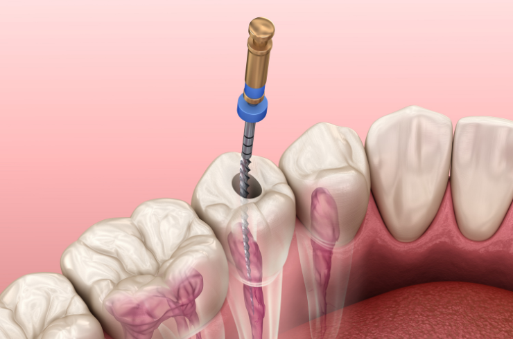 Endodontics
