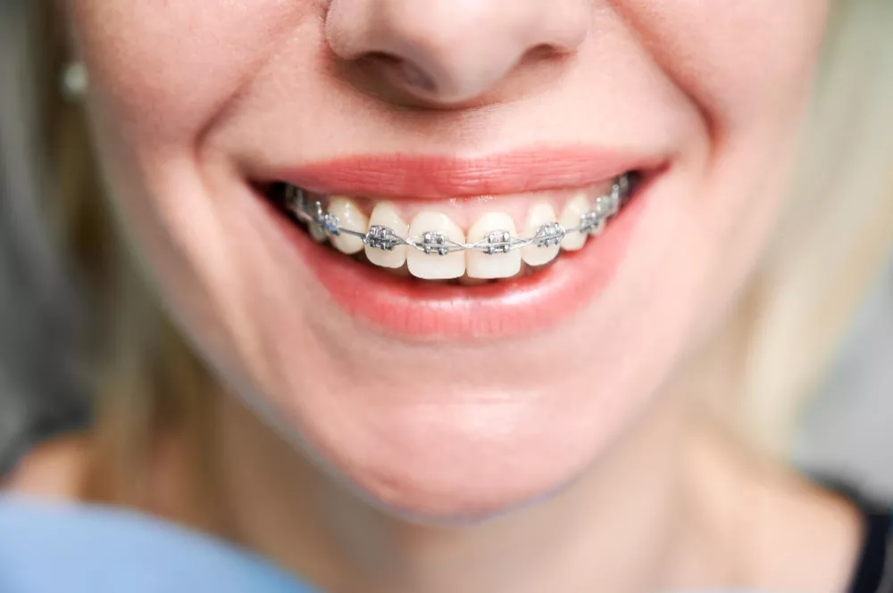 Aligners